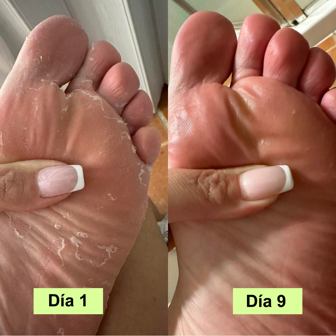 Jabón antihongos I Elimina el olor en tus pies